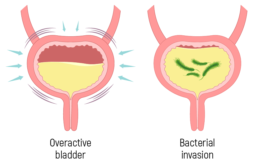 Cystitis And Utis Soluro